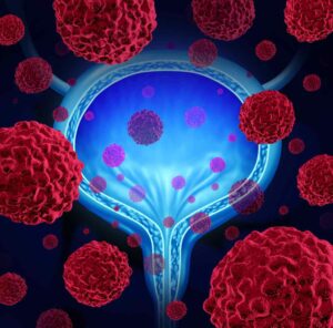 dr n. med. Mateusz Bilski, Radioterapeuta onkologiczny, Radioonkolog, Brachyterapeuta, Lublin, COZL, grafika przedstawia prostatę i komórki nowotworowe